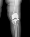 Ψηφιακή ακτινογραφία γόνατος
